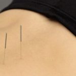 La acupuntura clínica, una estrategia terapéutica para aliviar el dolor